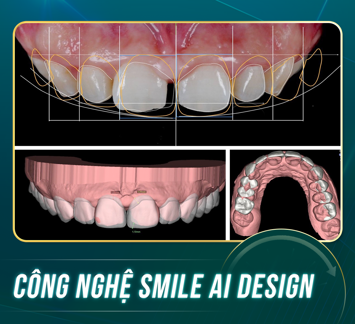 CONG NGHE SMILE AI DESIGN 2