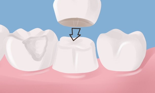 răng sứ orodent