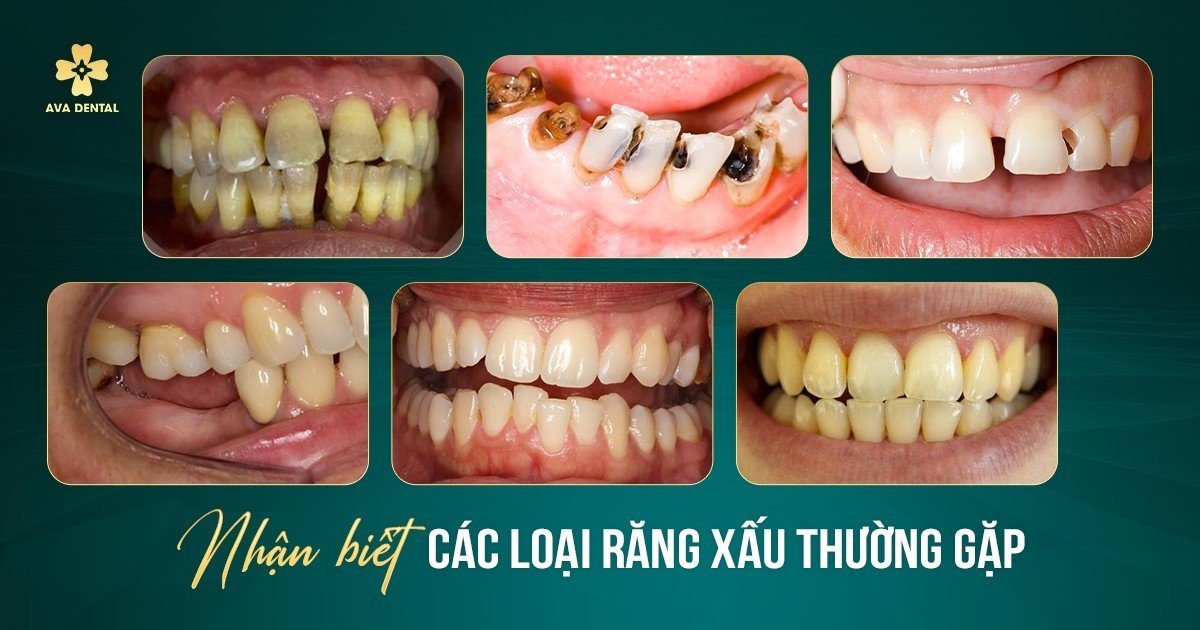 nhận biết răng xấu thường gặp
