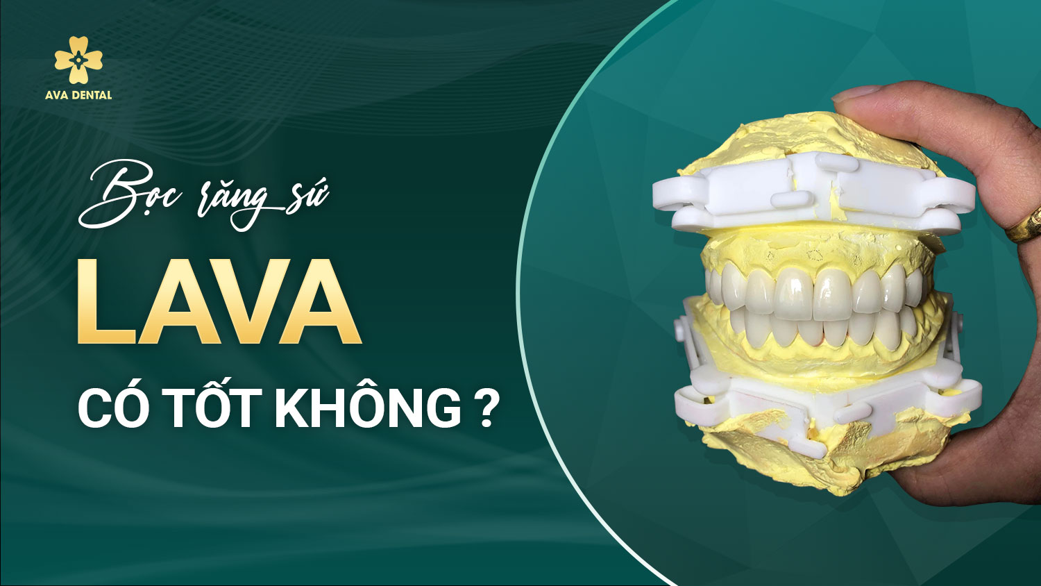 Bọc sứ lava
