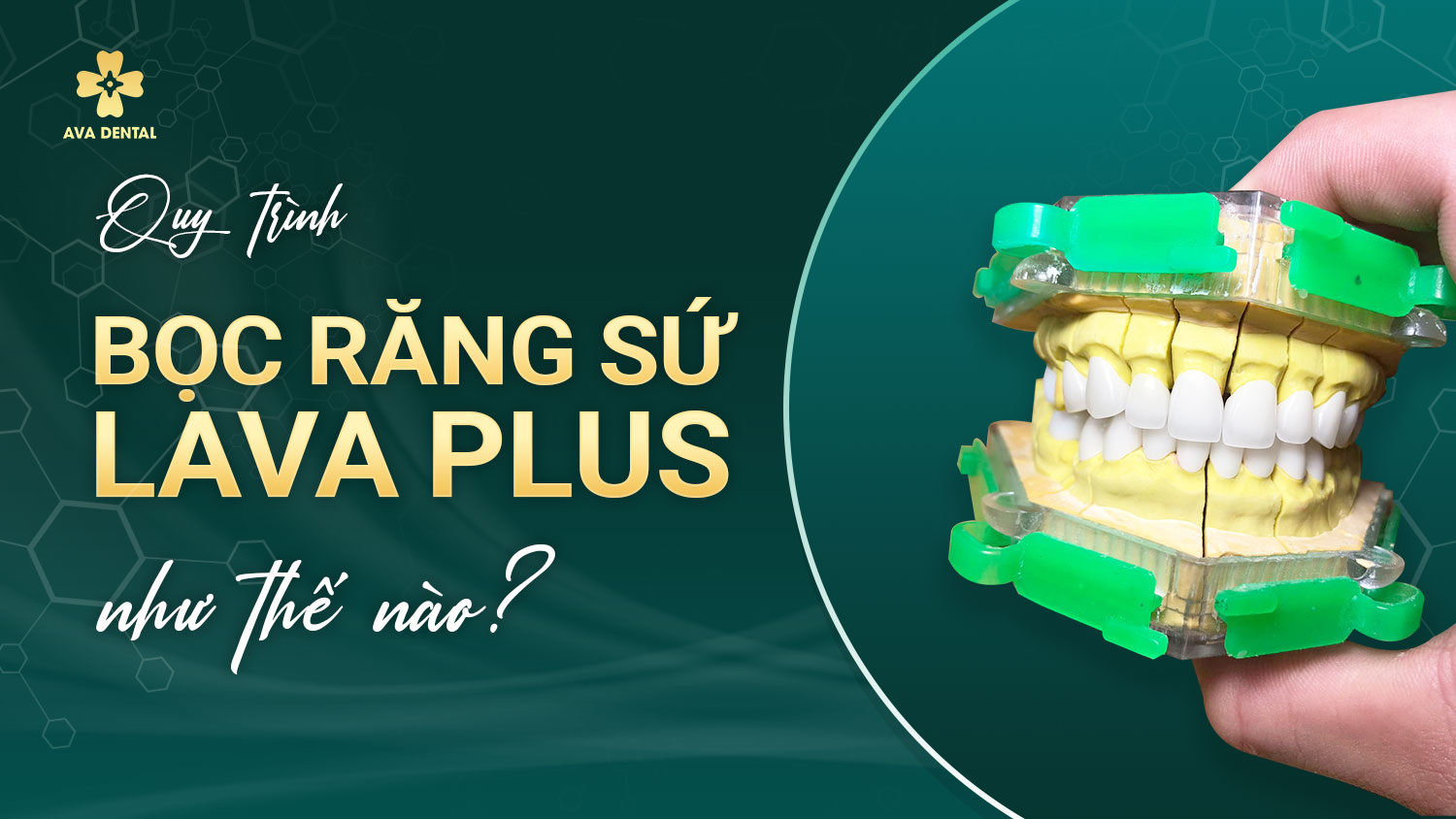 bọc sứ lava 