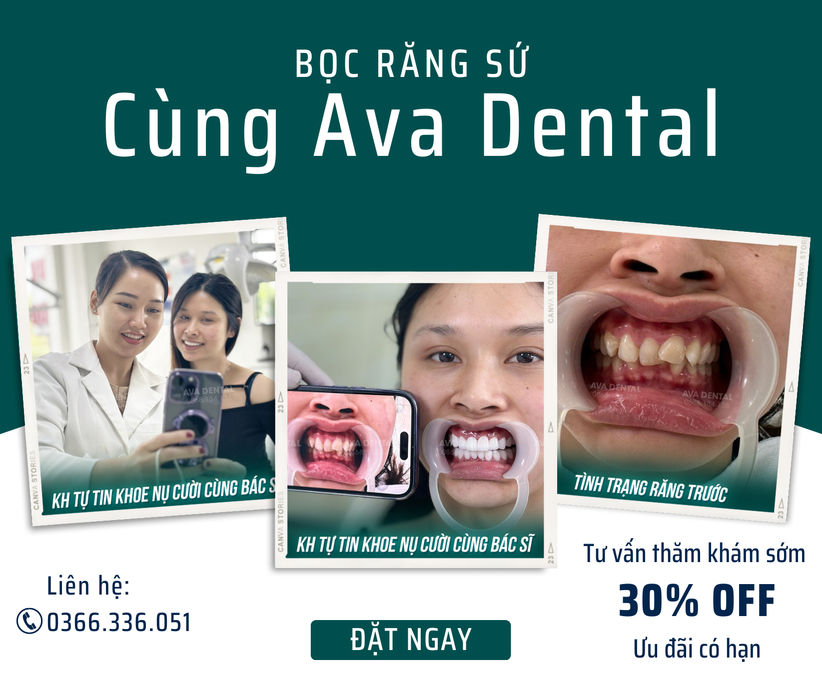 răng sứ 