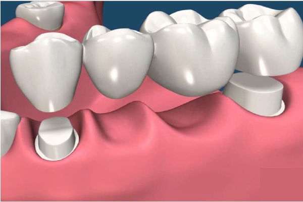 Rang su Ceramill Full 2