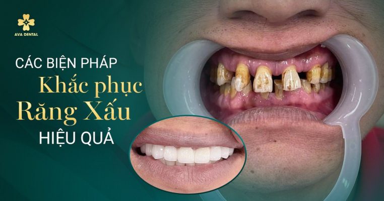 khắc phục răng xấu - bọc sứ orodent