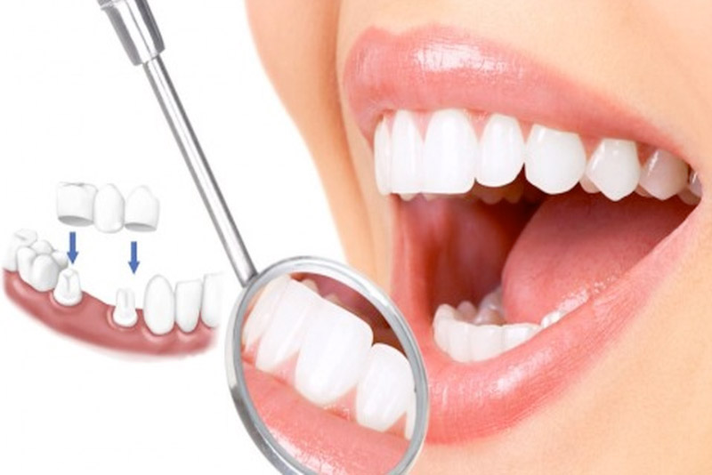 Bọc 20 răng sứ Orodent Bleach giá bao nhiêu ? 8 orodent