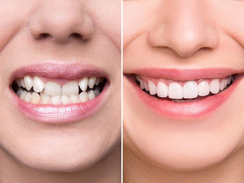 Răng Sứ số 1 Orodent - Thẻ Bảo Hành Răng Sứ Trọn Đời 7 dia chi boc rang su tot o ha noi thumb