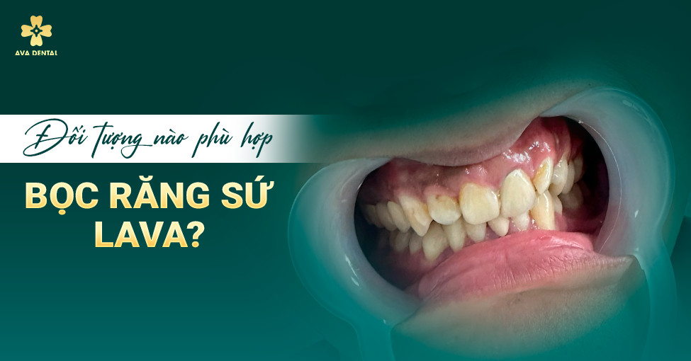 đối tượng nào bọc sứ lava ? 
