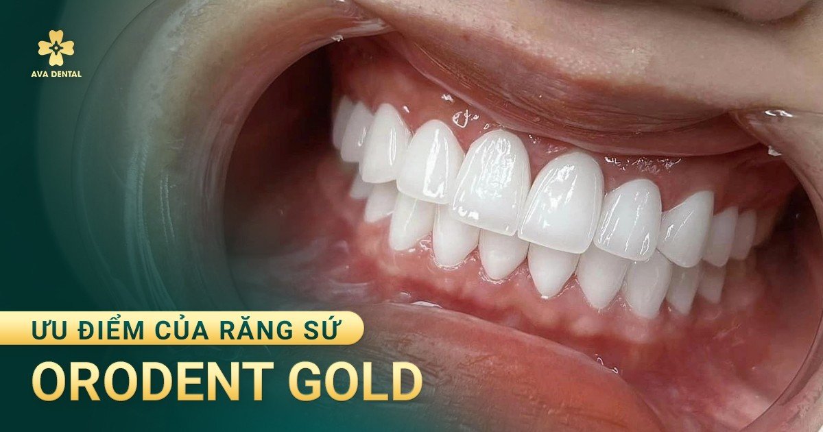 Răng Sứ Orodent Gold 15 f93ece7dc49019ce4081