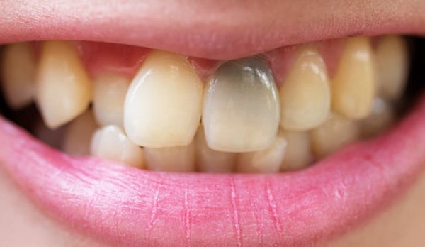 Răng sứ Orodent đến từ Ý an toàn nhất thế giới mới nhất 3/2023 12 răng chết tủy