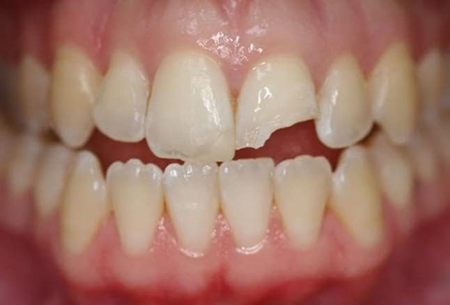 HIỂU ĐÚNG HIỂU ĐỦ VỀ DỊCH VỤ NHA KHOA TRÁM RĂNG 9 rang cua bi me phai lam sao