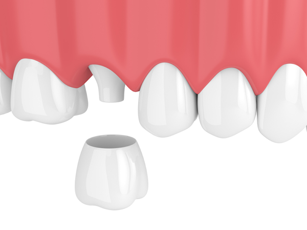 răng sứ orodent