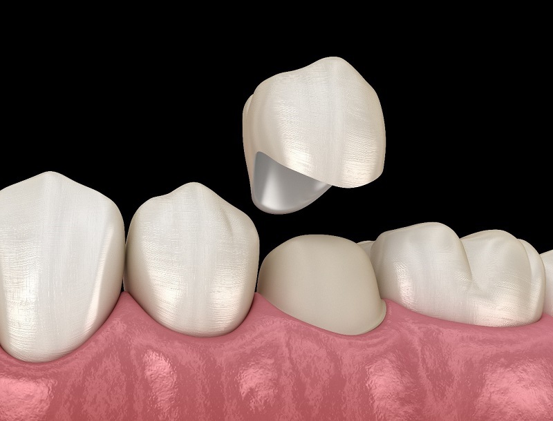 sứ orodent