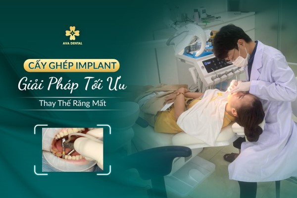 Bảng giá trồng răng Implant - Chi phí trồng răng Implant giá bao nhiêu