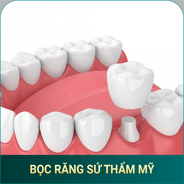 Bọc răng sứ thẩm mỹ Avora Dental