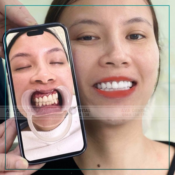 Có nên trồng răng Implant không?