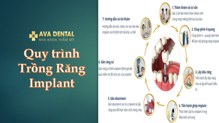 Trồng răng Implant là gì? - Cấy ghép implant - Hướng dẫn A-Z 6 Quy trinh trong rang Implant