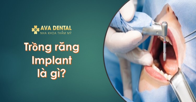 Trồng răng Implant là gì? - Cấy ghép implant - Hướng dẫn A-Z 5 Trong rang Implant la gi 1