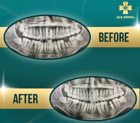 Trồng răng Implant là gì