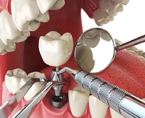 Mất Răng Lâu Năm Có Trồng Implant Được Không? 12 mất răng lâu năm có trồng implant được không