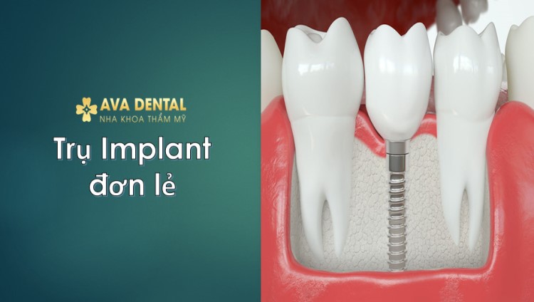 báo giá Trụ implant đơn lẻ