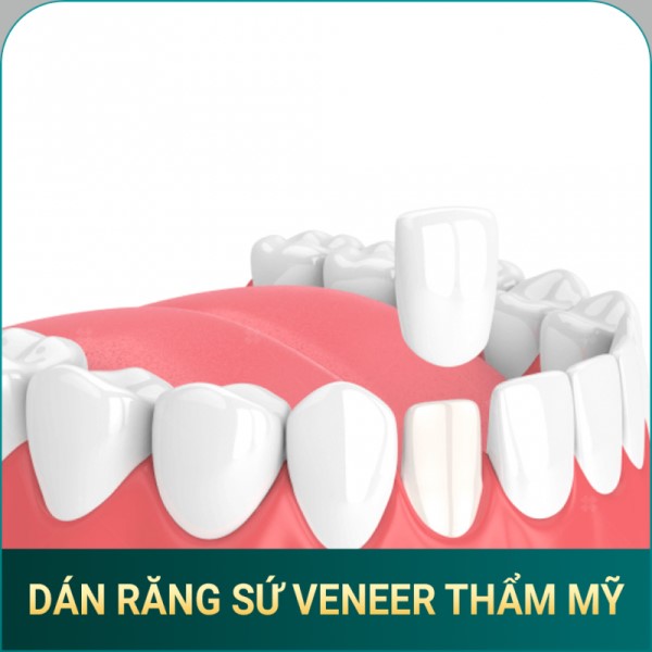 dan rang su veneer tham my AVA Dental