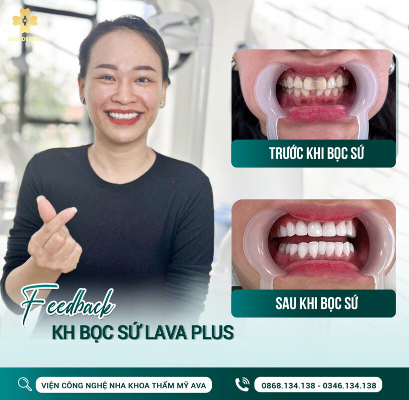 Độ tuổi bọc răng sứ là bao nhiêu? Trường hợp nào không nên bọc răng sứ 5 341855056 613189894032559 2873116820970763177 n