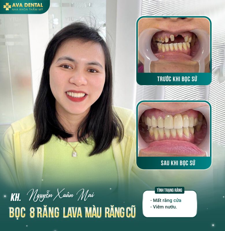 răng sứ lava