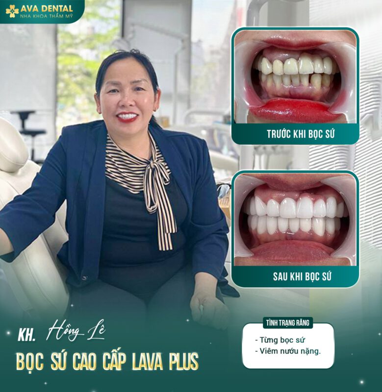 Bọc răng sứ có tốt không? Tác dụng của bọc răng sứ 4 349118816 2537986913027096 8353320228560600793 n 1