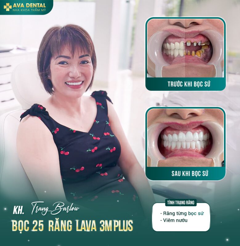 Răng Sứ Lava Esthetic