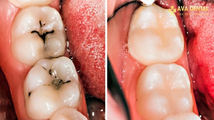 Bọc răng sứ cho răng sâu bao nhiêu tiền