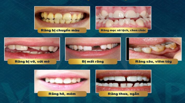 Các kiểu Bọc Răng Sứ Thẩm Mỹ thịnh hành nhất hiện nay