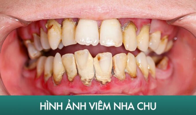 Giai Dap Thac Mac Viem Nha Chu La Gi 680x400 1