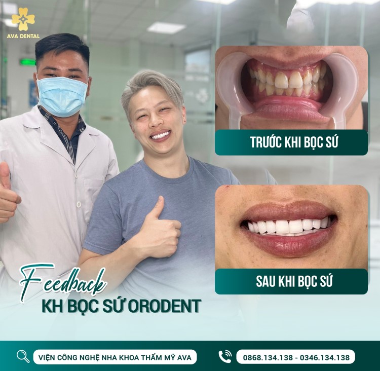 Phục hình răng sứ cao cấp: 10+ điều bạn cần biết 5 Hinh anh thuc te sau khi su dung Rang su Orodent Bleach