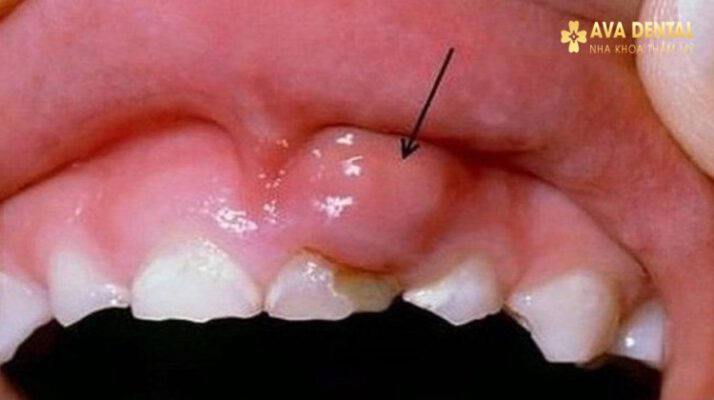 Nhiệt Lợi Chân Răng Là Gì