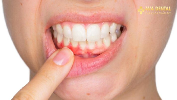 Những Điều Cần Biết Về Sưng Chân Răng