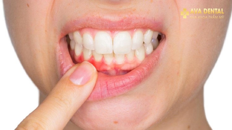 Những Điều Cần Biết Về Sưng Chân Răng