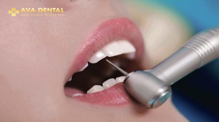 Những Lưu Ý Về Mài Răng Bọc Sứ Mà Bạn Nên Biết