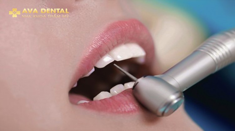 Những lưu ý về mài răng bọc sứ mà bạn nên biết 4 Những Lưu Ý Về Mài Răng Bọc Sứ Mà Bạn Nên Biết