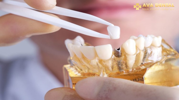 Phục hình răng sứ cao cấp: 10+ điều bạn cần biết 4 Phục hình răng sứ cao cấp là gì