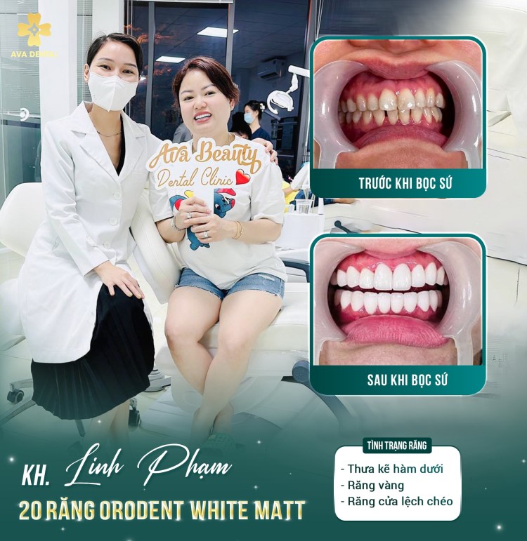 Răng sứ Orodent White Matt - Bật mí những điều thú vị 12 orodent white matt