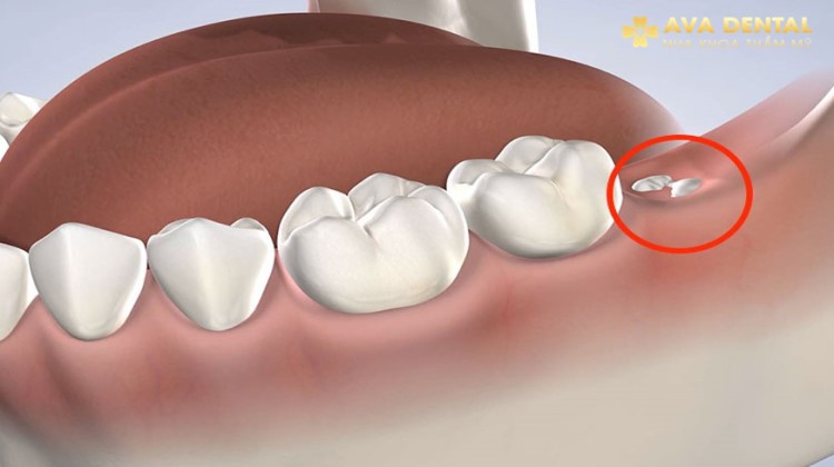 Răng số 8 là răng nào? Những điều cần biết về răng số 8 5 Răng Số 8 Là Răng Nào
