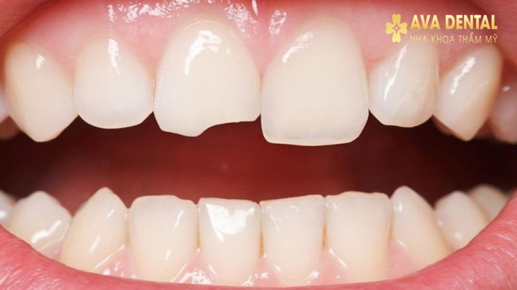 Kiến thức nha khoa: Răng sứ bị mẻ có trám được không? 3 Răng Sứ Bị Mẻ Có Trám Được Không