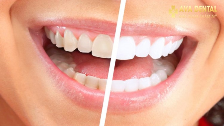 Răng sứ có bị ố vàng không? Nguyên nhân và cách khắc phục 4 Răng sứ có bị ố vàng không