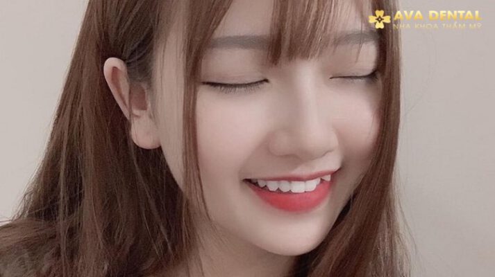 Trồng Răng Khểnh Giá Bao Nhiêu
