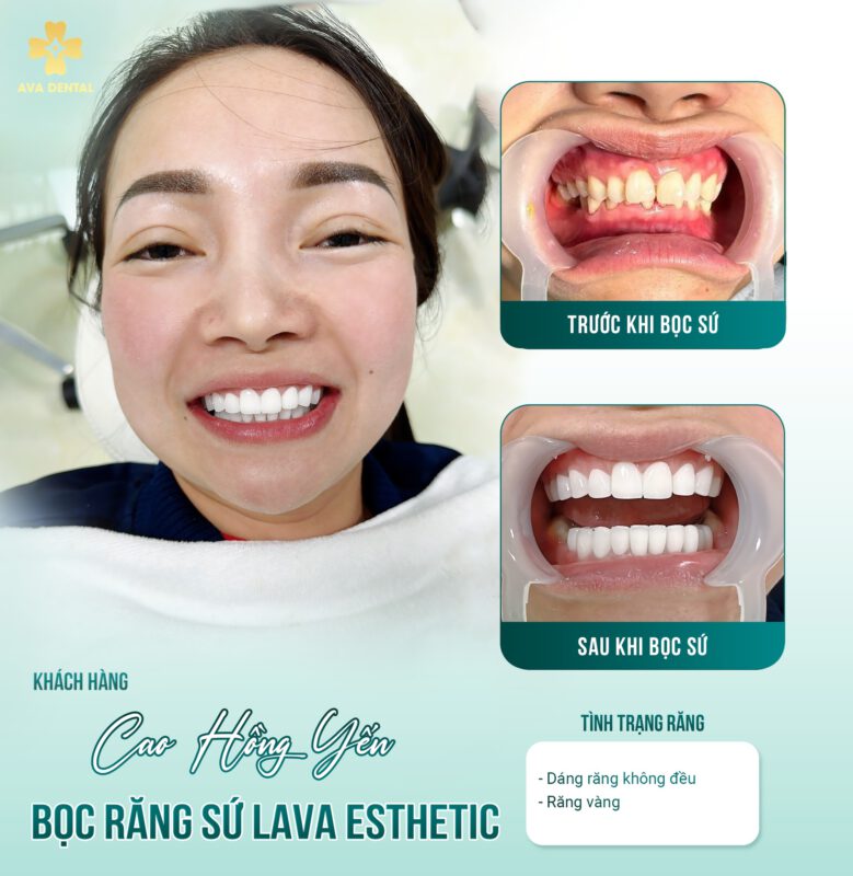 Cách chăm sóc răng sau khi bọc răng sứ 4 343316293 576724491222739 1604052678019571707 n