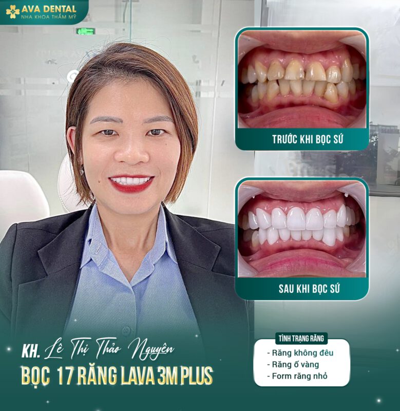 Sở hữu nụ cười hoàn hảo với răng sứ Orodent High Translucent Zirconia 4 346058645 1231211540866470 5987208829557338110 n
