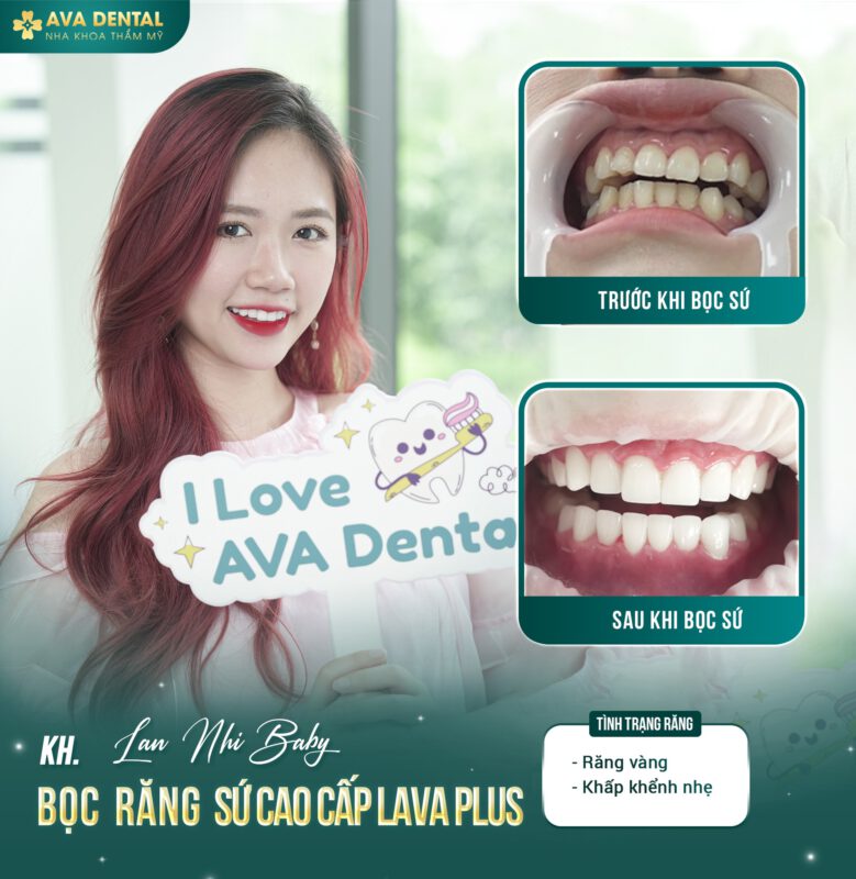 Răng Sứ Lava Esthetic