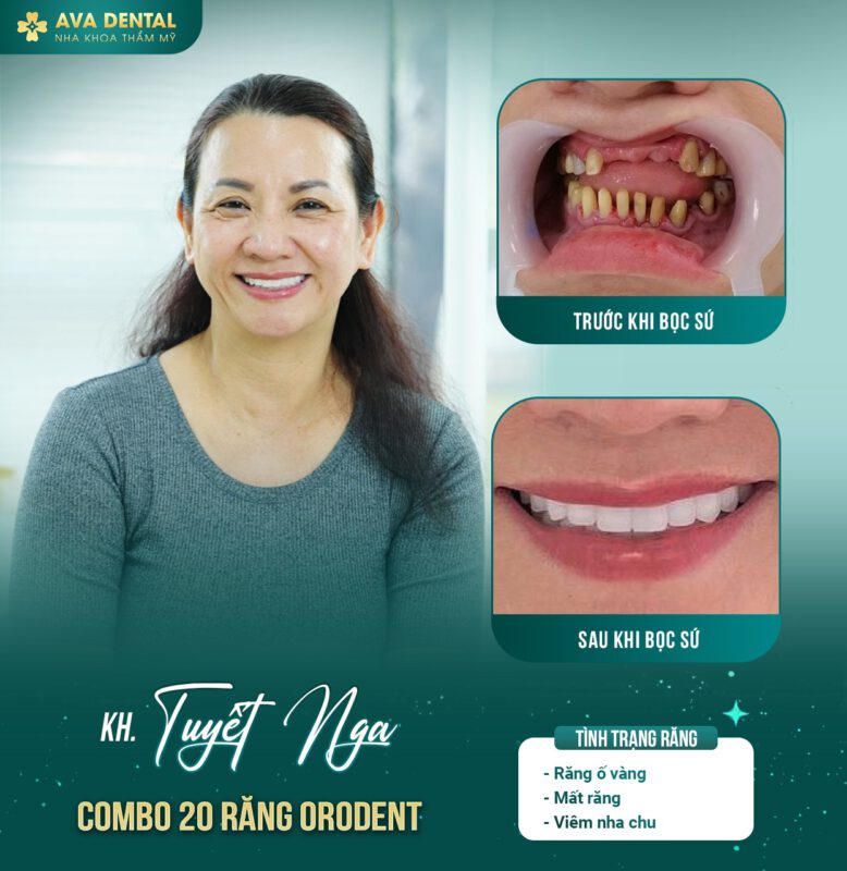 Khám phá các loại răng sứ phổ biến thị trường hiện nay 7 370292556 678077281018279 3883121708203934987 n