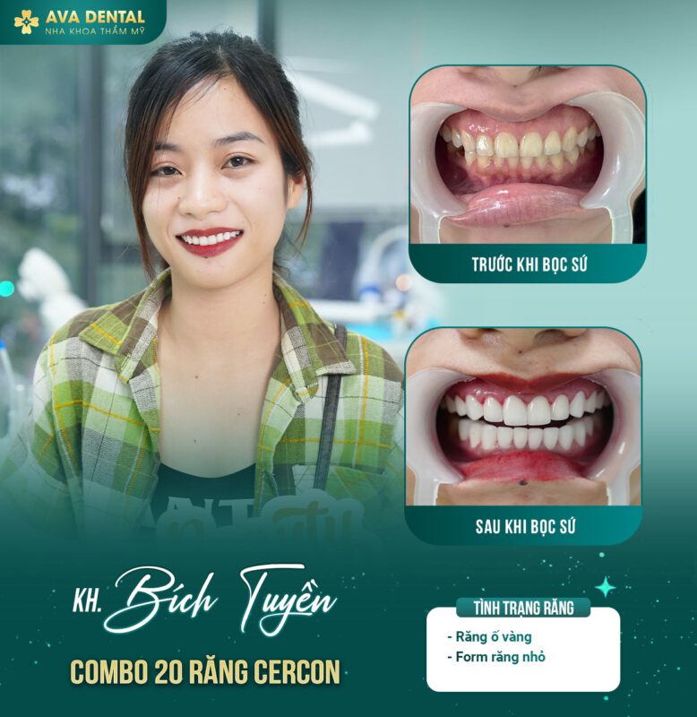 Phương pháp trồng răng hàm hiệu quả 6 370639305 678077177684956 615754573277233974 n