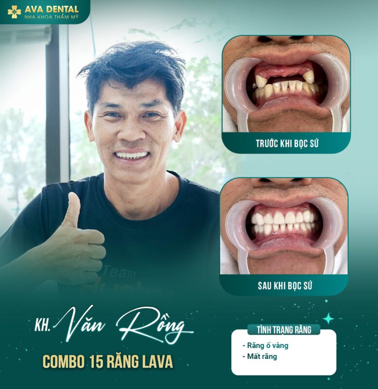Khám phá những lợi ích của răng sứ thẩm mỹ 6 371986220 678077237684950 1346878988921426100 n
